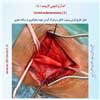 اندآرترکتومی کاروتید 5