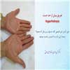تعریق بیش از حد دست
