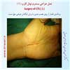 عمل سندرم تونل کارپ 1