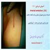 آمبولی شریانی 10