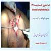 ادم لنفاوی کیسه بیضه 3