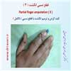 آمپوتاسیون 3