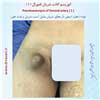 انوریسم کاذب شریان فمورال 1