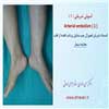آمبولی شریانی 1