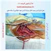 اندآرترکتومی کاروتید 8