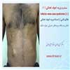 سندرم اجوف تحتانی 1