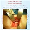 سندرم خروجی قفسه سینه5