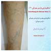 اسکلروتراپی 3