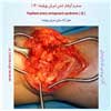 سندرم گرفتار شدن شریان پوپلیته 16