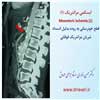 ایسکمی مزانتریک 1