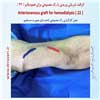 رگ مصنوعی بازو 22