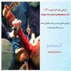 جراحی لنف ادم شدید 13
