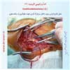 اندآرترکتومی کاروتید 11