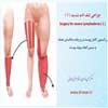 جراحی لنف ادم شدید 1