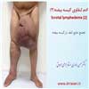 ادم لنفاوی کیسه بیضه 2