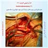 اندآرترکتومی کاروتید 7