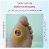 پای دیابتی نروپاتی 1