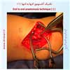 آناستوموز انتها به انتها 1
