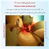 سندرم خروجی قفسه سینه 4