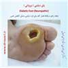 پای دیابتی نروپاتی 2
