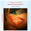 سندرم گرفتار شدن شریان پوپلیته 7