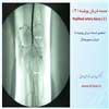 صدمه شریان پوپلیته 2