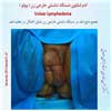 ادم لنفاوی وولو