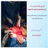جراحی لنف ادم شدید 8