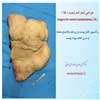 جراحی لنف ادم شدید 15