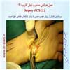 عمل سندرم تونل کارپ 2
