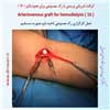 رگ مصنوعی بازو 16
