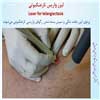 لیزر واریس تارعنکبوتی