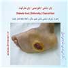پای دیابتی دفورمیتی 2