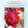 برداشتن غدد پارا آئورت 3
