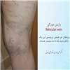 واریس مویرگی