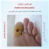 پای دیابتی نروپاتی 3