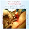 سندرم خروجی قفسه سینه 8