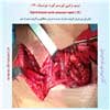 هیبرید انوریسم توراسیک 19
