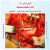آمبولی شریانی 18