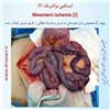 ایسکمی مزانتریک 2