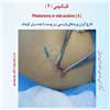 فلبکتومی 4