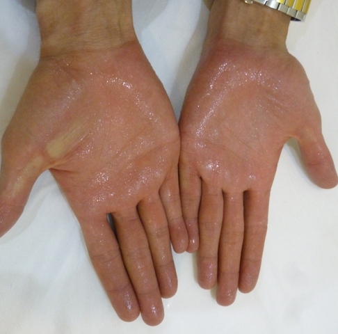 تعریق بیش از حد دست ( Hyperhidrosis )
